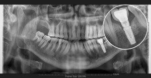 dental implant